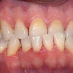 TRATTAMENTO ORTODONTICO LINGUALE INVISIBILE WIN- III CLASSE