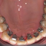 TRATTAMENTO ORTODONTICO LINGUALE INVISIBILE WIN- III CLASSE