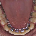 TRATTAMENTO ORTODONTICO LINGUALE INVISIBILE WIN- III CLASSE