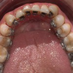 TRATTAMENTO ORTODONTICO LINGUALE INVISIBILE WIN- III CLASSE