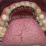 TRATTAMENTO ORTODONTICO LINGUALE INVISIBILE WIN- III CLASSE