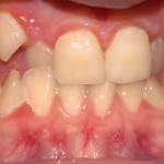 TRATTAMENTO ORTODONTICO VESTIBOLARE ESTICO AFFOLAMENTO IMPORTANTE
