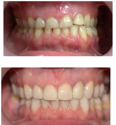 Le faccette dentali in ceramica
