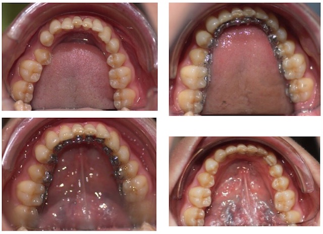 Morso Profondo - Trattamento Ortodontico Linguale Invisibile