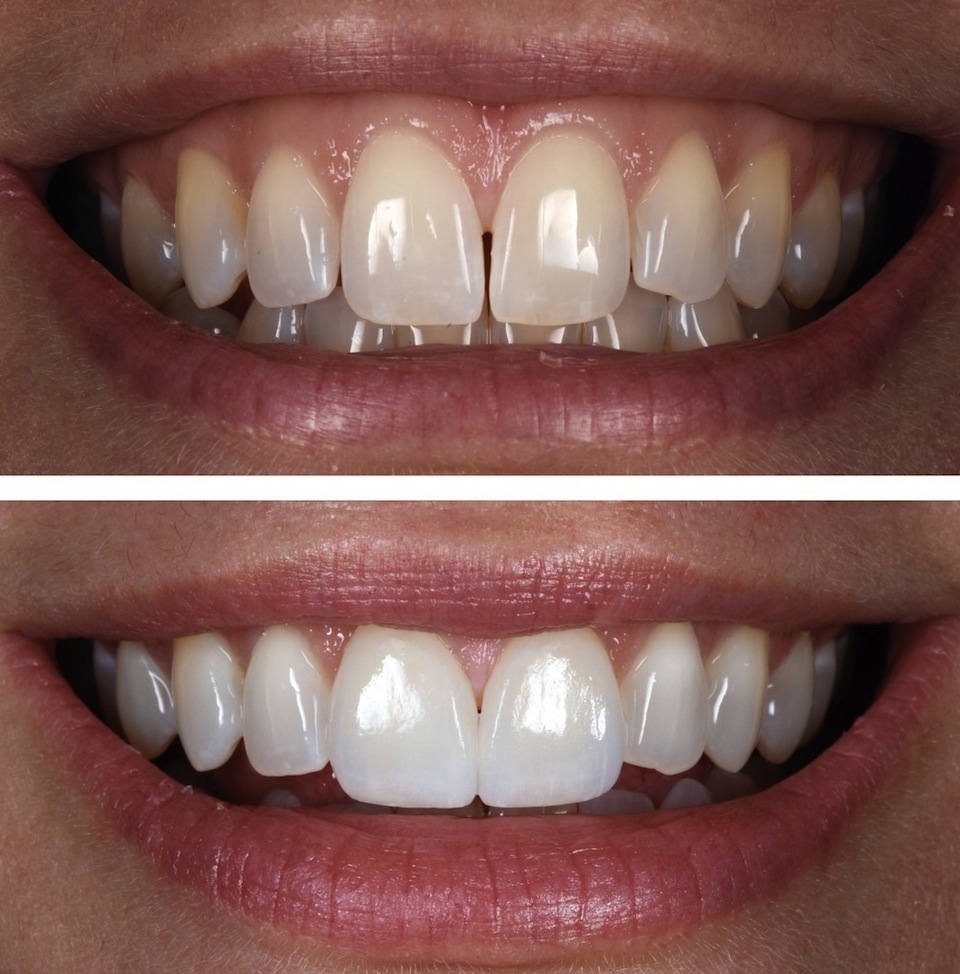 Le faccette dentali in ceramica minimamente invasive