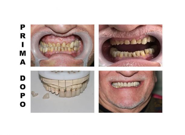 Faccette dentali : Cosa sono, indicazioni, controindicazioni, cura e consigli.