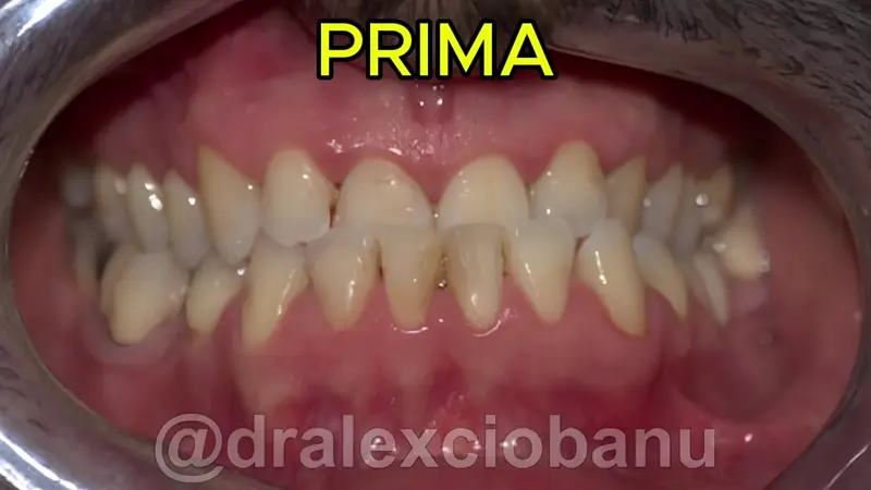 Caso Clinico Prognatismo Mandibolare Prima - Dopo