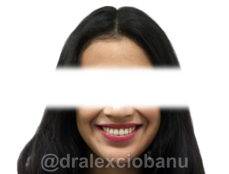 Caso-clinico-AFFOLAMENTO-DENTALE-1-Dopo