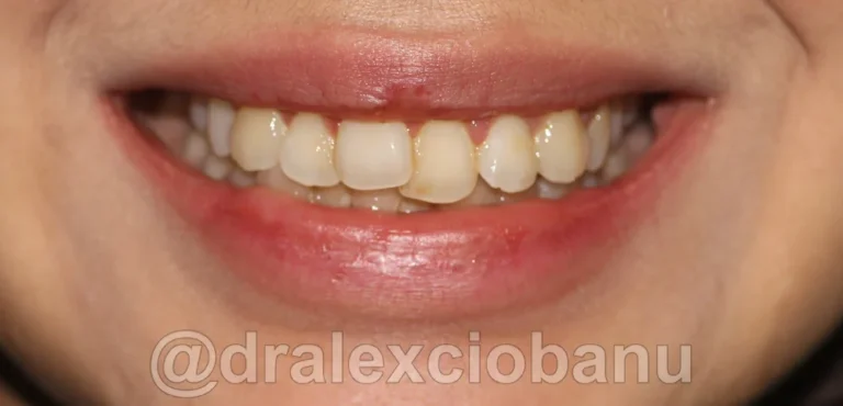 Caso-clinico-AFFOLAMENTO-DENTALE-2-Prima-1