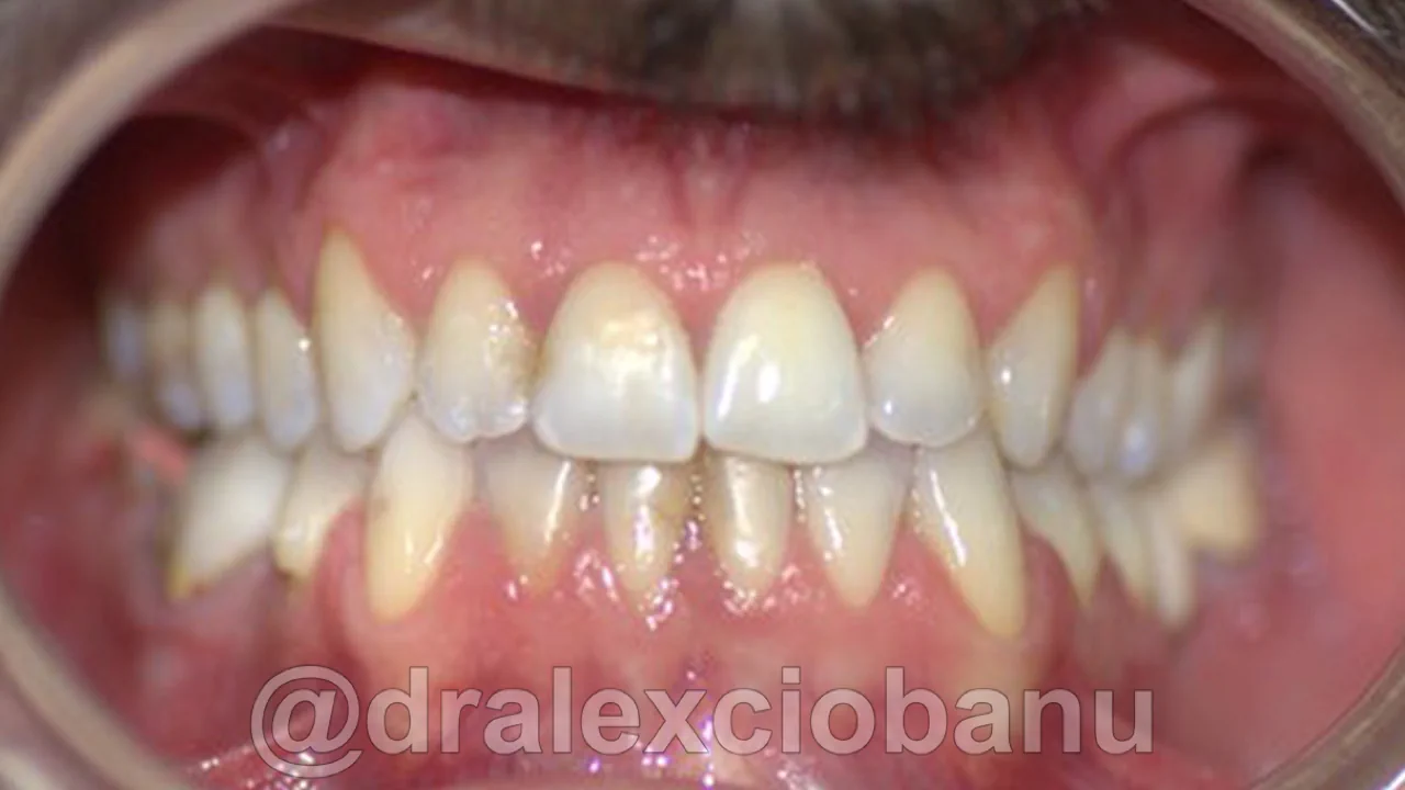 Caso clinico PROGNATISMO MANDIBOLARE Dopo