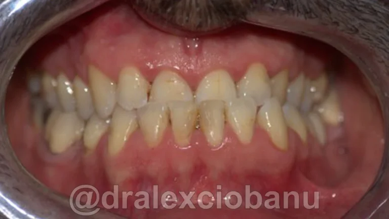 Caso-clinico-PROGNATISMO-MANDIBOLARE-Prima-1