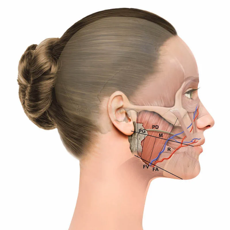 Trattamento Dell’ Ipertonia - Ipertrofia Dei Masseteri Botulino