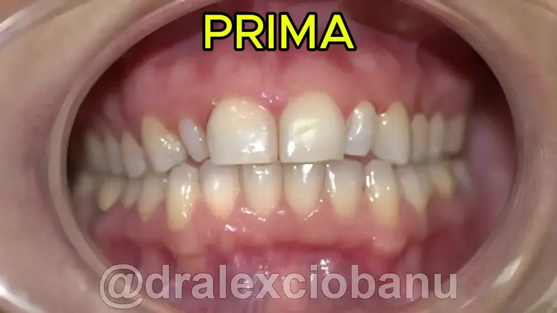 Caso Clinico Faccette Dentali Ceramica - Prima - Dopo