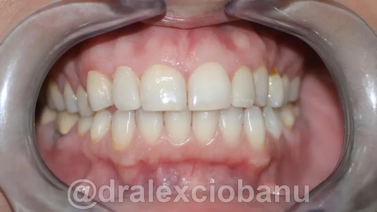 Dopo FACCETTE-DENTALI