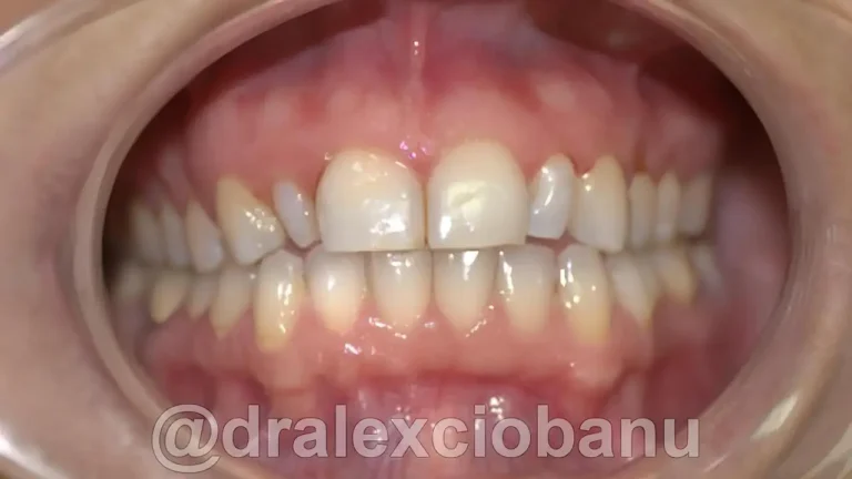 Prima FACCETTE-DENTALI