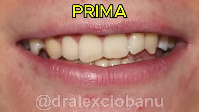 Caso Clinico Morso Profondo Prima - Dopo