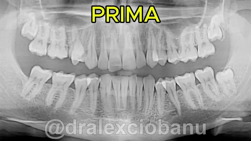 Caso Clinico Morso Profondo Prima - Dopo
