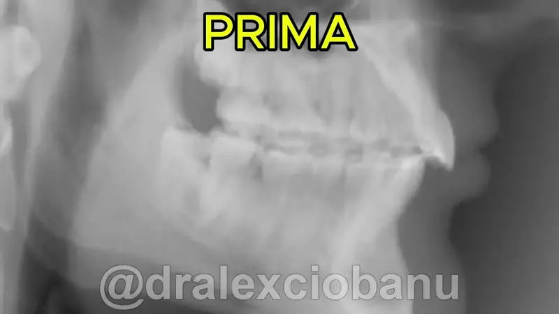 Caso Clinico Morso Profondo Prima - Dopo