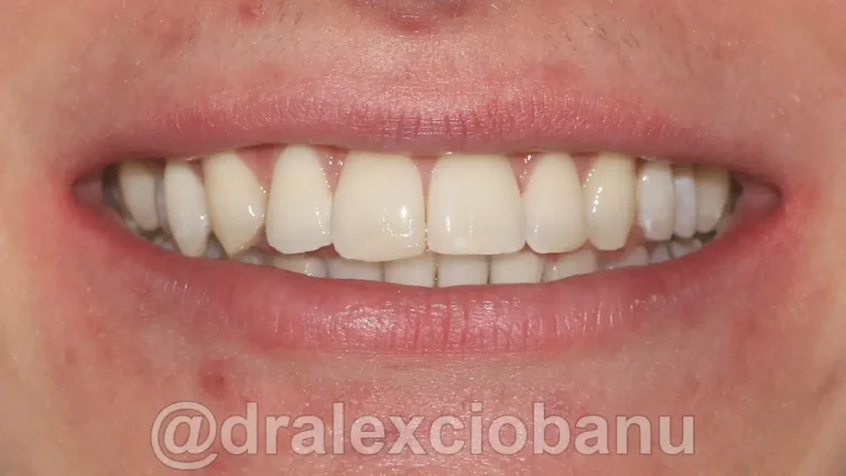 Caso clinico MORSO PROFONDO dopo