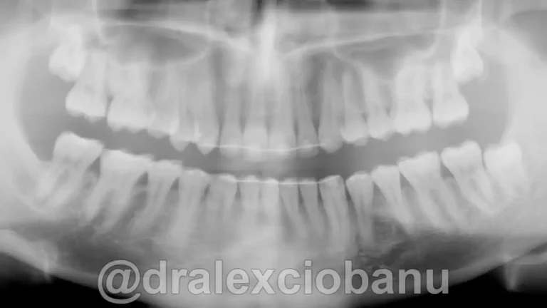 Caso clinico MORSO PROFONDO dopo