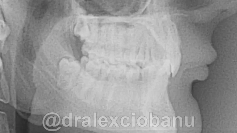 Caso clinico MORSO PROFONDO dopo