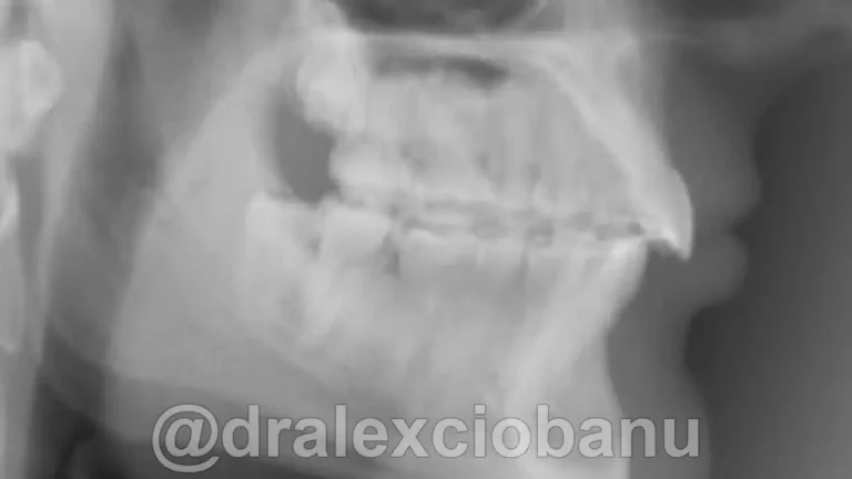 Caso clinico MORSO PROFONDO prima