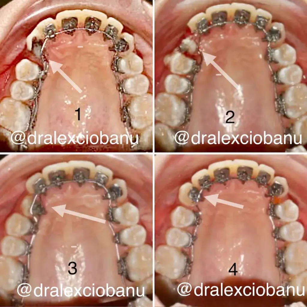 Recupero Chirurgico e Ortodontico dei Canini Inclusi 1-4