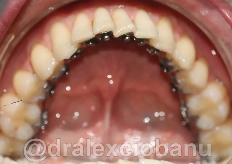 Morso Inverso Arcata Inferiore - Prima