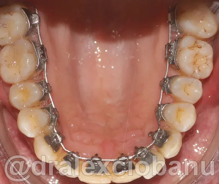 Morso Inverso Arcata Superiore - Dopo