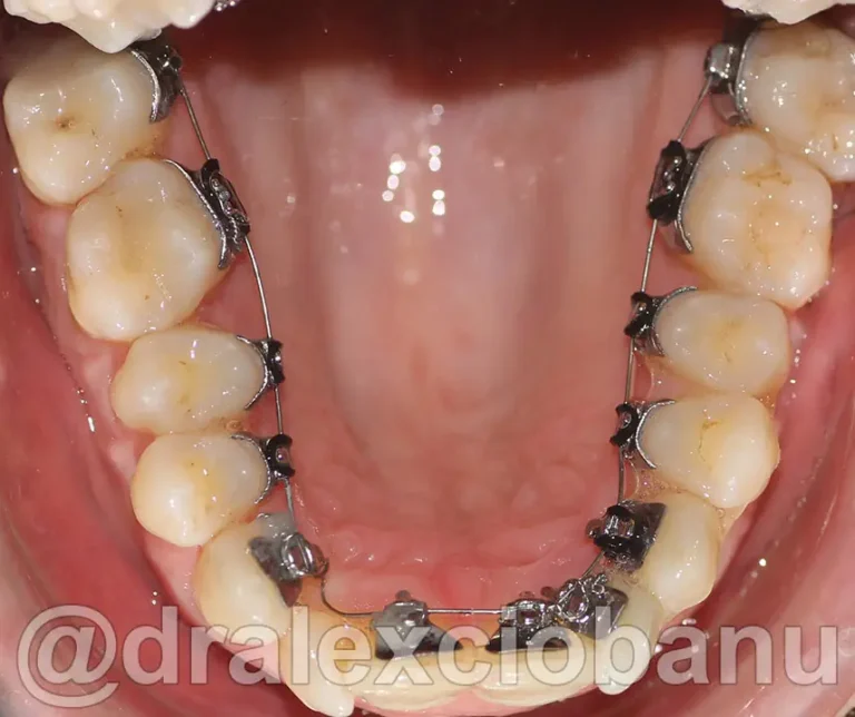 Morso Inverso Arcata Superiore - Prima