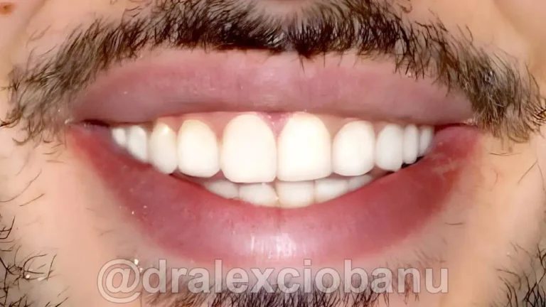 Dopo - Correggere gli spazi tra i denti