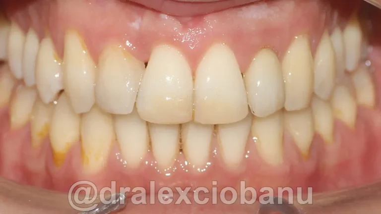 Morso Inverso - Dopo