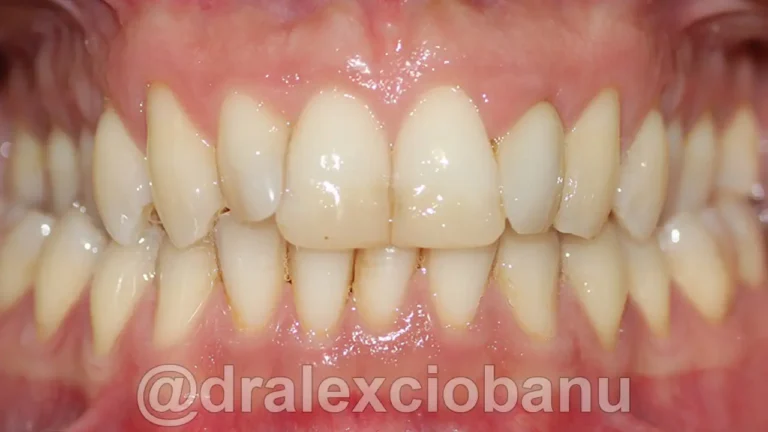 Morso Inverso - Prima