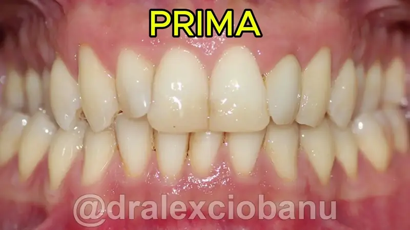 Morso Inverso - Prima - Dopo