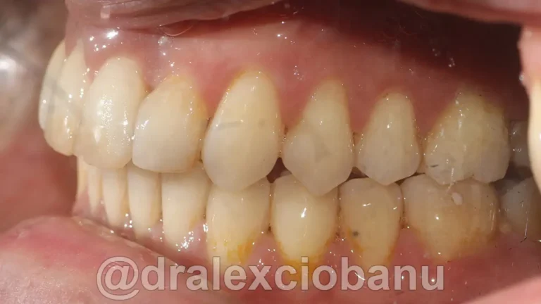 Morso Inverso 2 - Dopo