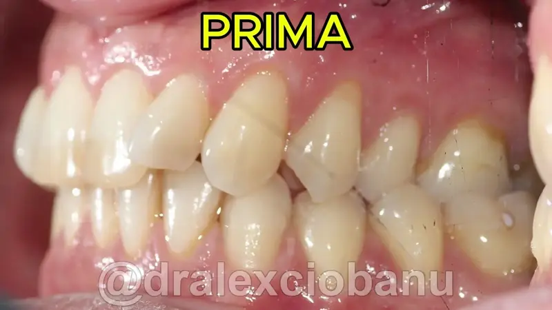 Morso Inverso - Prima - Dopo