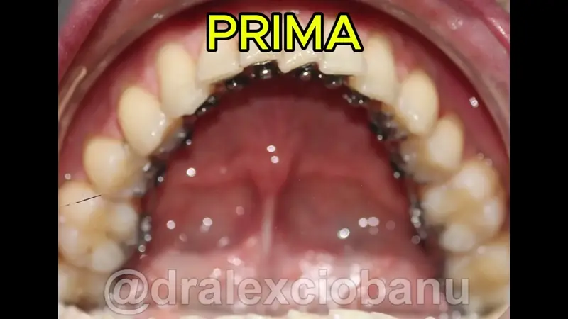 Morso Inverso Arcata Inferiore - Prima - Dopo