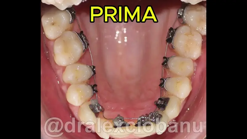 Morso Inverso Arcata Superiore - Prima - Dopo