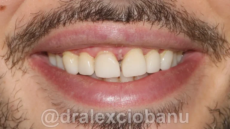 Prima - Correggere gli spazi tra i denti