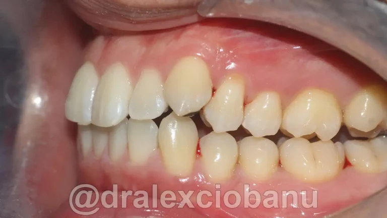 Caso clinico - Affolamento Dentale - Prima
