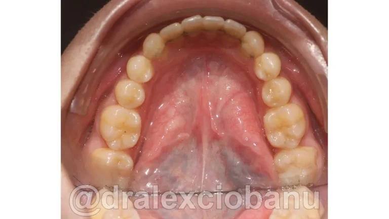 Caso clinico - Affolamento Dentale 3 - Dopo
