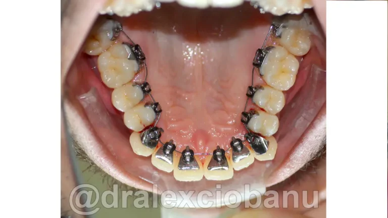Caso clinico - Affolamento Dentale 4- Prima