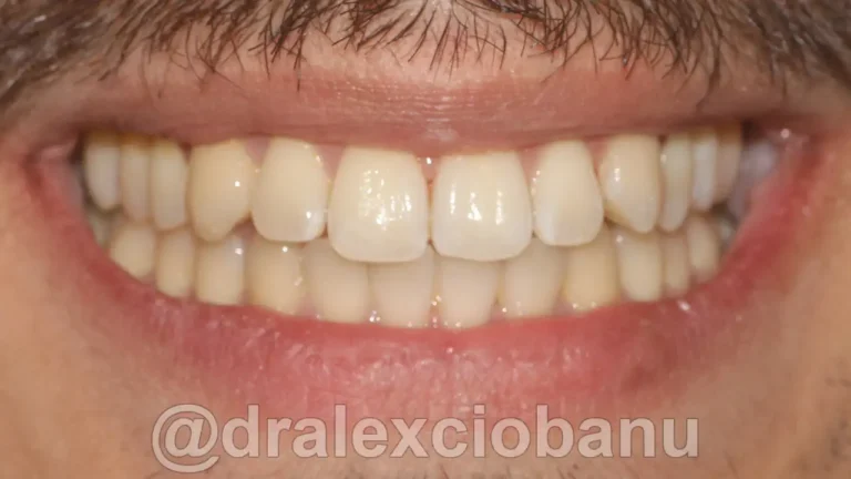 Caso clinico - Affolamento Dentale - Dopo