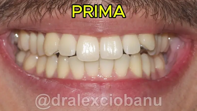 Caso clinico - Affolamento Dentale - Prima - Dopo