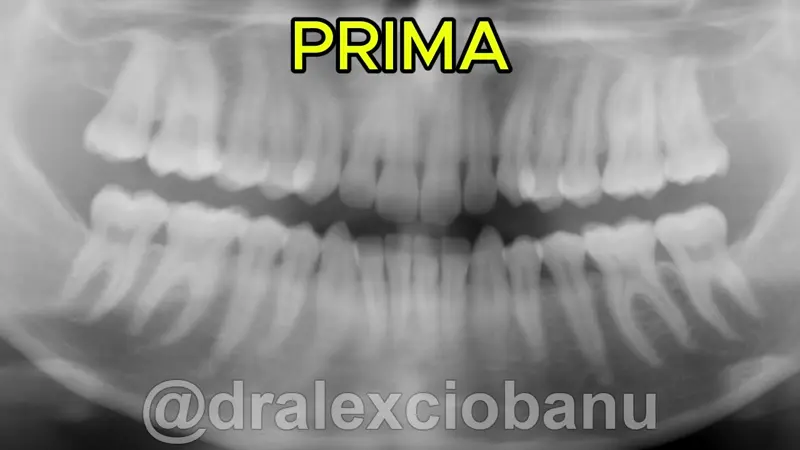 Caso clinico - Affolamento Dentale - Prima - Dopo
