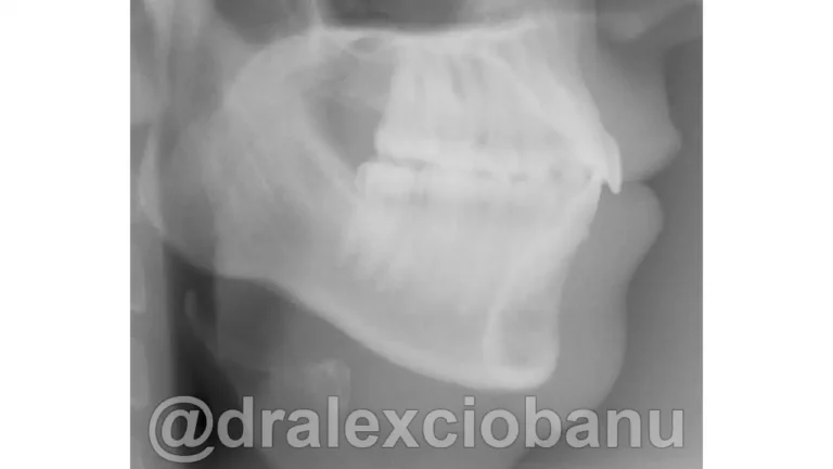Caso clinico - Affolamento Dentale - Prima