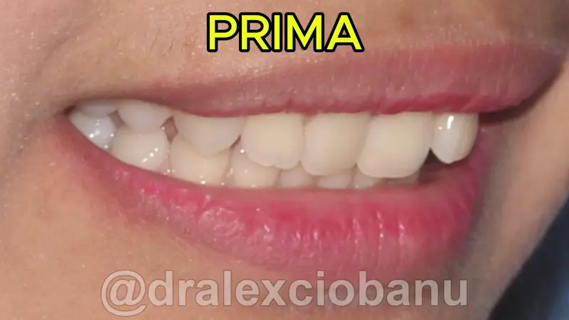 Caso clinico Morso Profondo - Prima - Dopo