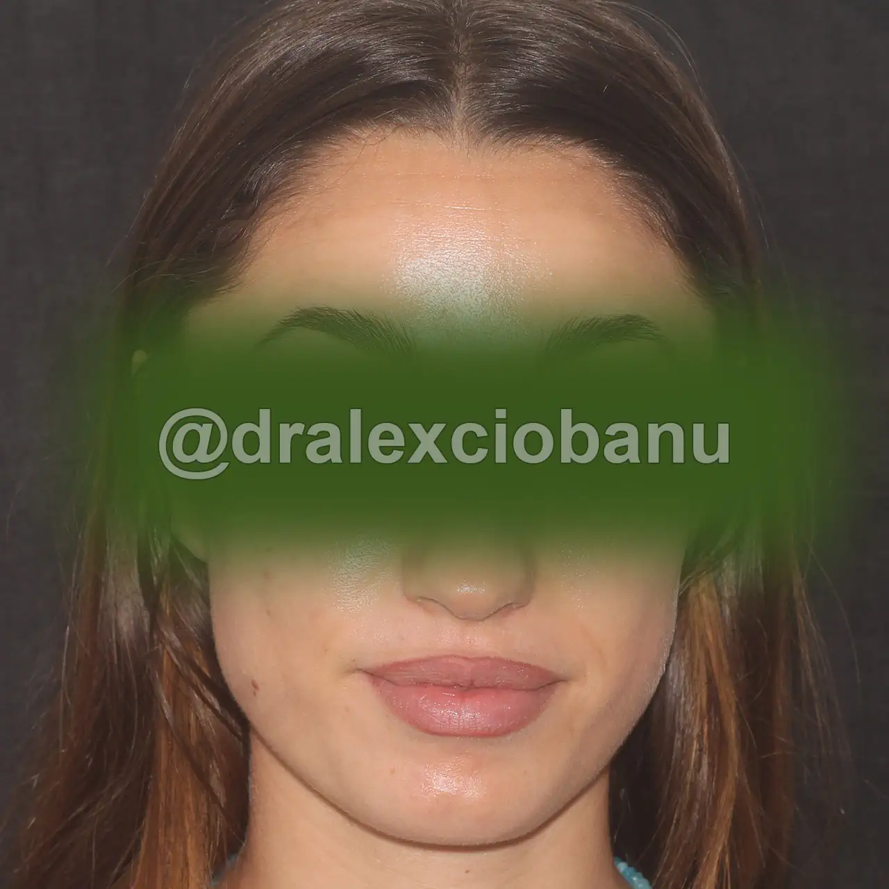 Caso Clinico Botox Fronte - dopo