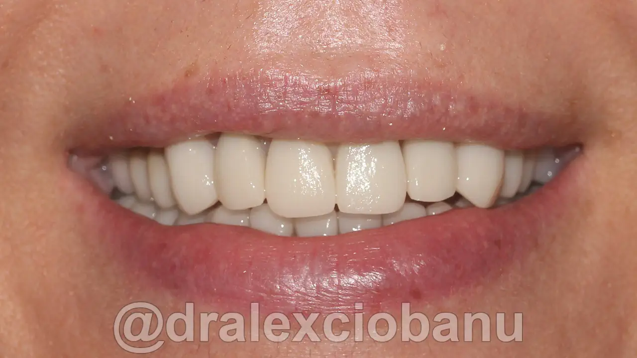 Caso Clinico Corone in Ceramica Integrale e Corone su Impianti