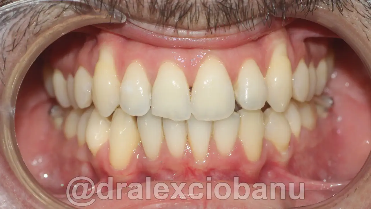 Caso clinico Affolamento dentale dopo